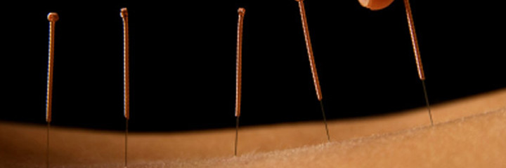 Acupuncture