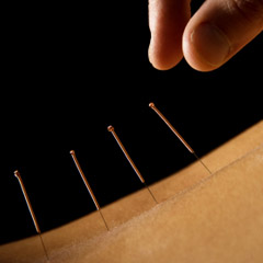 Acupuncture Gosforth