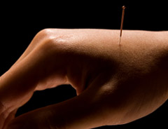 acupuncture treatment