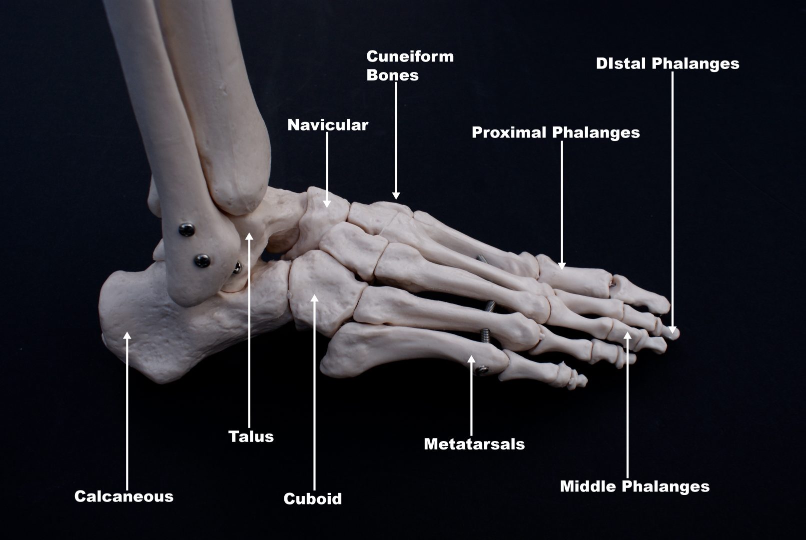 5th metatarsal fractures - Newcastle Physiotherapy